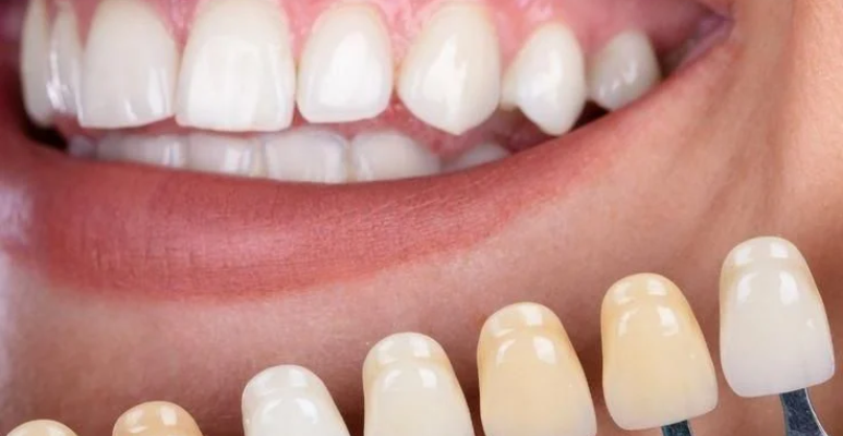 Best full mouth rehabilitation (14)