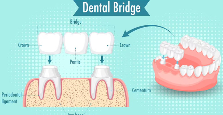 Best full mouth rehabilitation (3)