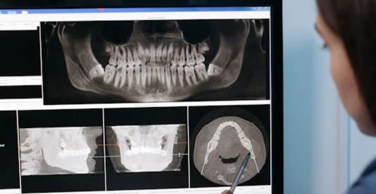 Best full mouth rehabilitation (4)
