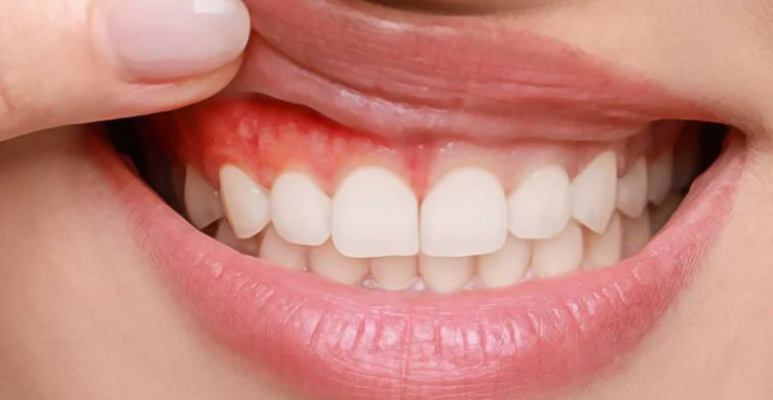Best full mouth rehabilitation (7)